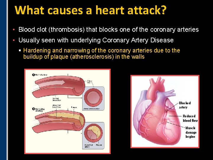 What causes a heart attack? • Blood clot (thrombosis) that blocks one of the What causes a heart attack? • Blood clot (thrombosis) that blocks one of the