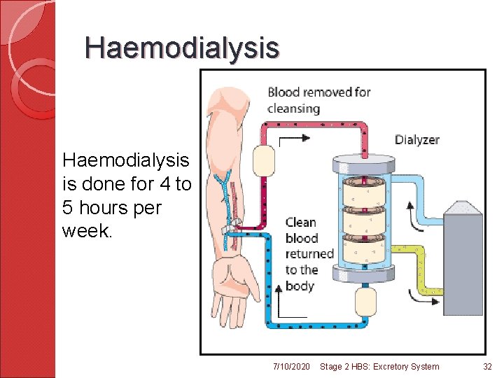 Haemodialysis is done for 4 to 5 hours per week. 7/10/2020 Stage 2 HBS: