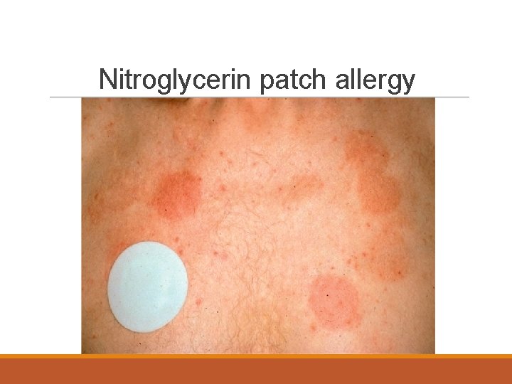 Nitroglycerin patch allergy 