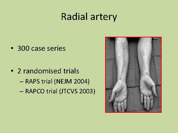 Radial artery • 300 case series • 2 randomised trials – RAPS trial (NEJM