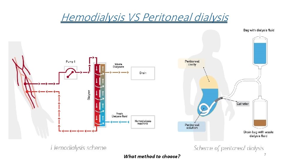 Hemodialysis VS Peritoneal dialysis What method to choose? 7 
