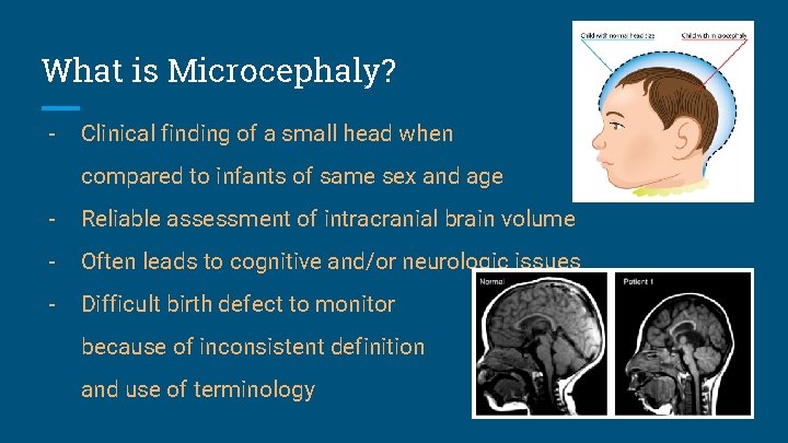 What is Microcephaly? - Clinical finding of a small head when compared to infants