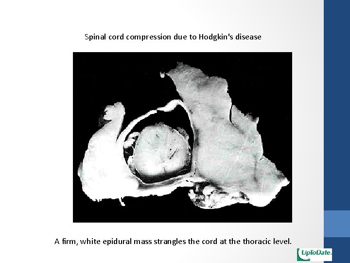 Spinal cord compression due to Hodgkin's disease A firm, white epidural mass strangles the