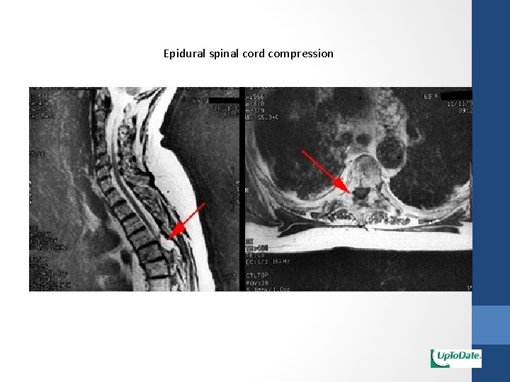 Epidural spinal cord compression 