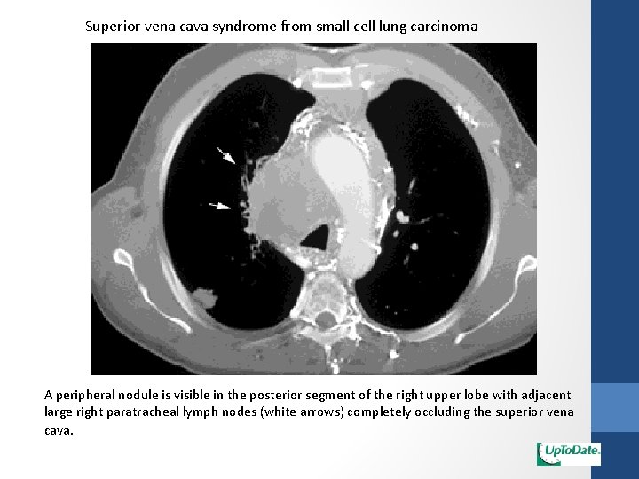 Superior vena cava syndrome from small cell lung carcinoma A peripheral nodule is visible