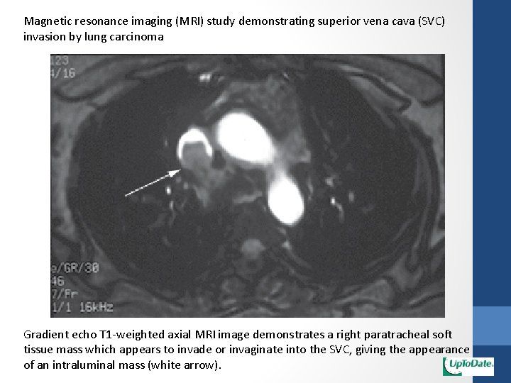 Magnetic resonance imaging (MRI) study demonstrating superior vena cava (SVC) invasion by lung carcinoma