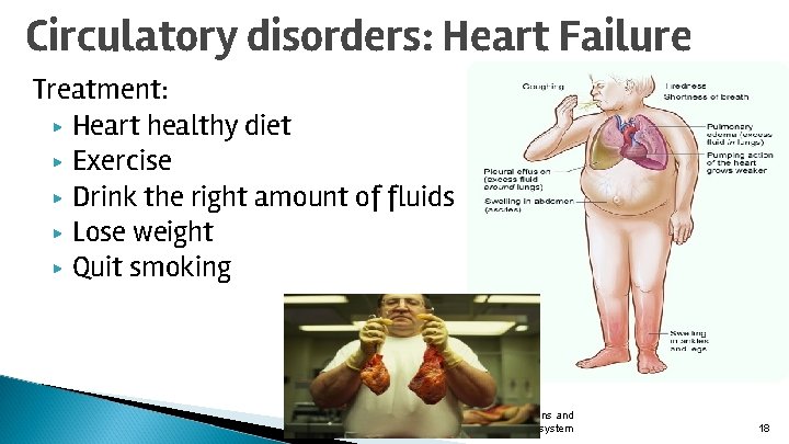 Circulatory disorders: Heart Failure Treatment: ▶ Heart healthy diet ▶ Exercise ▶ Drink the