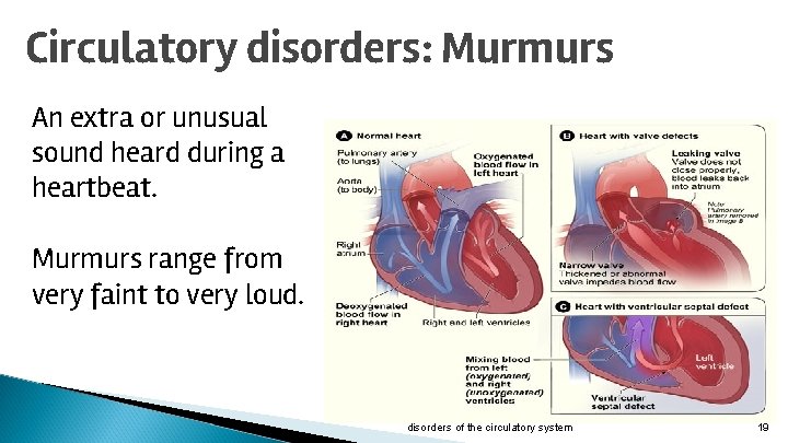 Circulatory disorders: Murmurs An extra or unusual sound heard during a heartbeat. Murmurs range