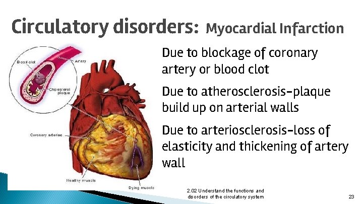 Circulatory disorders: Myocardial Infarction Due to blockage of coronary artery or blood clot Due