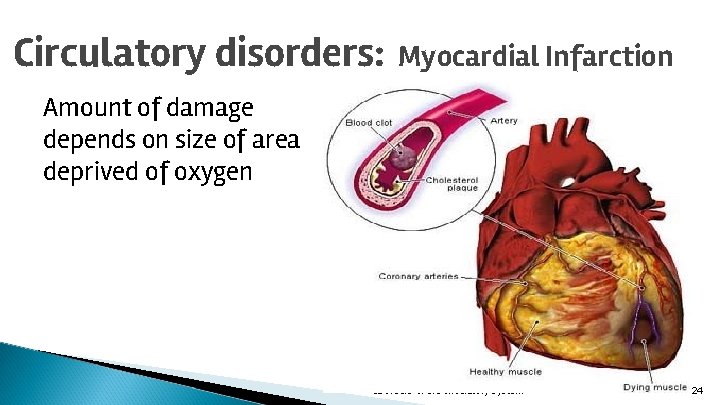 Circulatory disorders: Myocardial Infarction Amount of damage depends on size of area deprived of