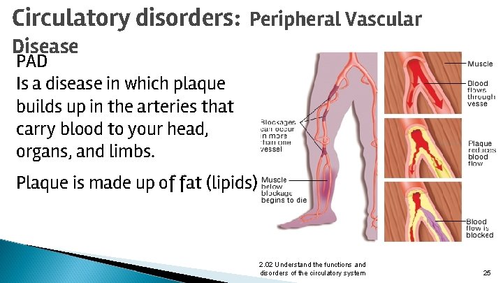 Circulatory disorders: Peripheral Vascular Disease PAD Is a disease in which plaque builds up