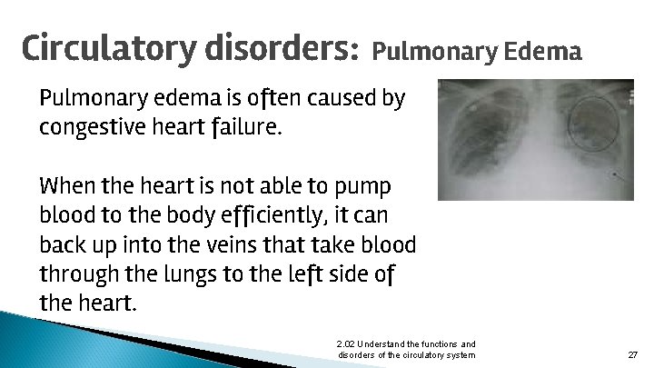Circulatory disorders: Pulmonary Edema Pulmonary edema is often caused by congestive heart failure. When