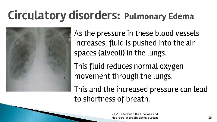 Circulatory disorders: Pulmonary Edema As the pressure in these blood vessels increases, fluid is