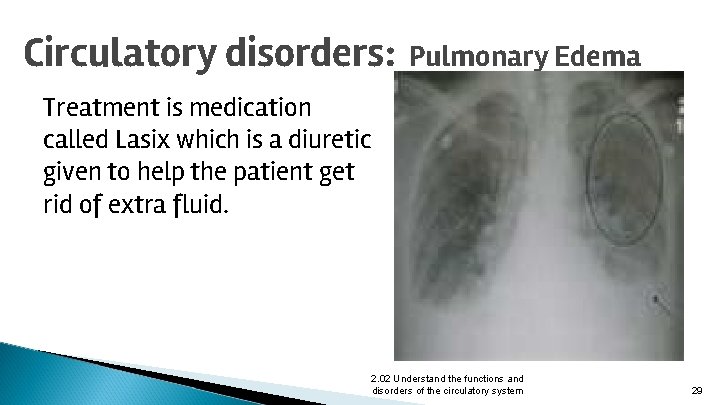 Circulatory disorders: Pulmonary Edema Treatment is medication called Lasix which is a diuretic given