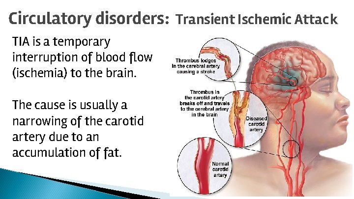 Circulatory disorders: Transient Ischemic Attack TIA is a temporary interruption of blood flow (ischemia)