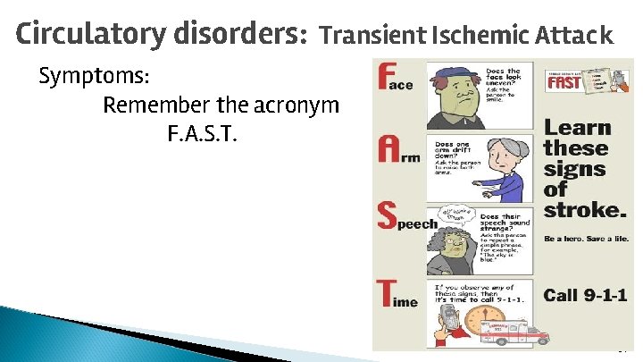 Circulatory disorders: Transient Ischemic Attack Symptoms: Remember the acronym F. A. S. T. 31