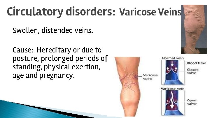 Circulatory disorders: Varicose Veins Swollen, distended veins. Cause: Hereditary or due to posture, prolonged