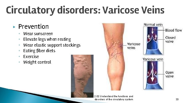 Circulatory disorders: Varicose Veins ▶ Prevention ◦ ◦ ◦ Wear sunscreen Elevate legs when