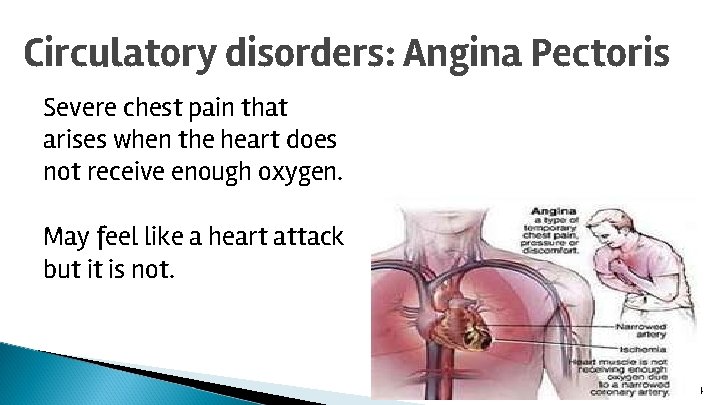 Circulatory disorders: Angina Pectoris Severe chest pain that arises when the heart does not
