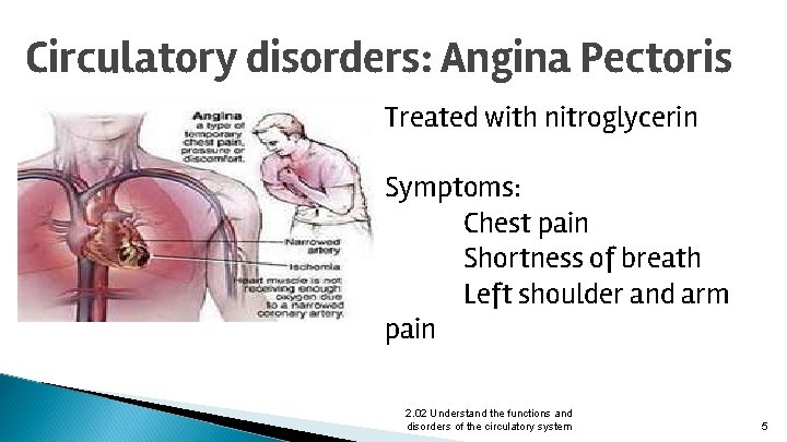 Circulatory disorders: Angina Pectoris Treated with nitroglycerin Symptoms: Chest pain Shortness of breath Left