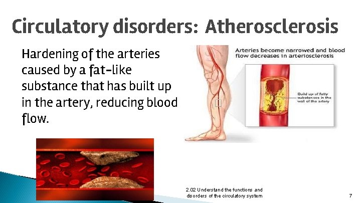 Circulatory disorders: Atherosclerosis Hardening of the arteries caused by a fat-like substance that has