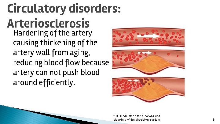 Circulatory disorders: Arteriosclerosis Hardening of the artery causing thickening of the artery wall from