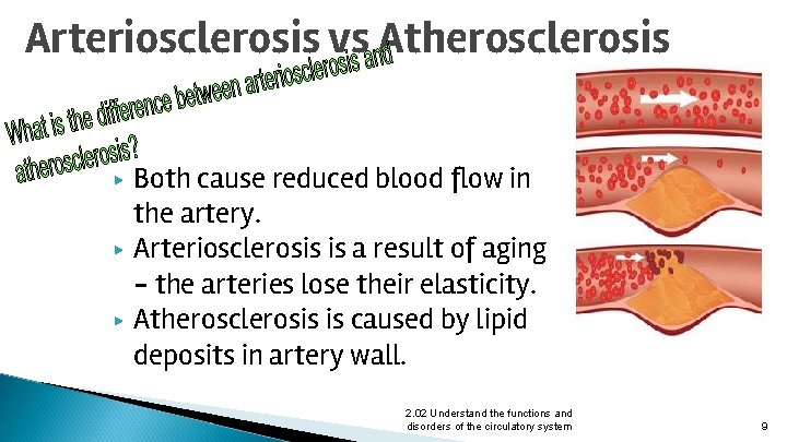 Arteriosclerosis vs Atherosclerosis ▶ ▶ ▶ Both cause reduced blood flow in the artery.
