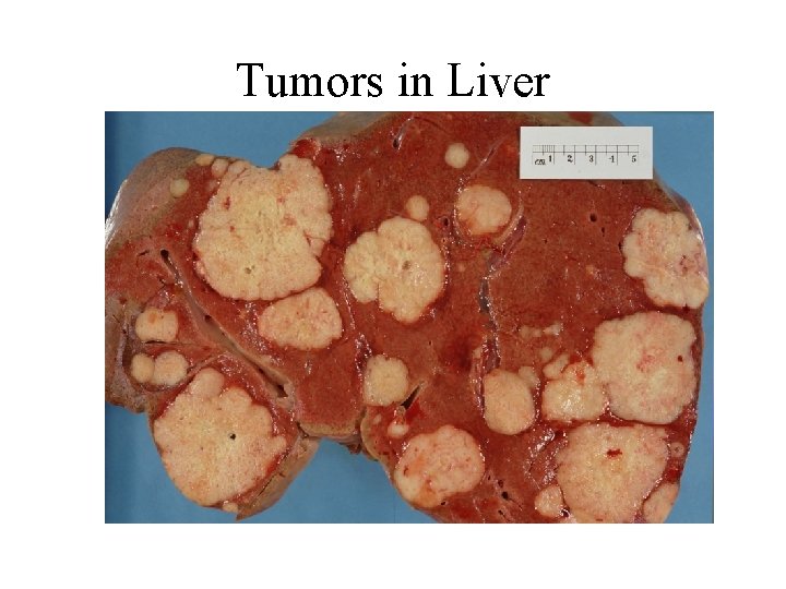Tumors in Liver 