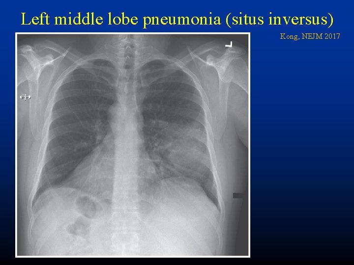 Left middle lobe pneumonia (situs inversus) Kong, NEJM 2017 