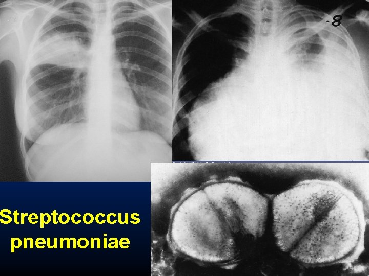 Streptococcus pneumoniae 