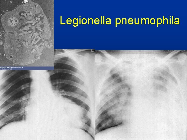 Legionella pneumophila 