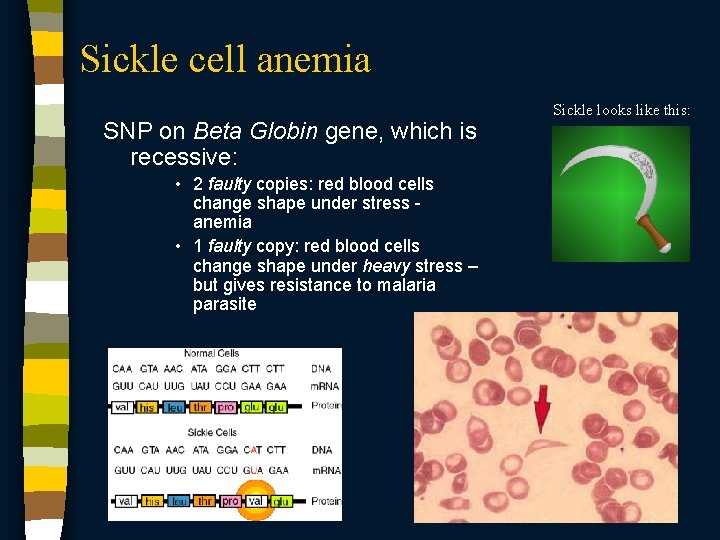 Sickle cell anemia SNP on Beta Globin gene, which is recessive: • 2 faulty