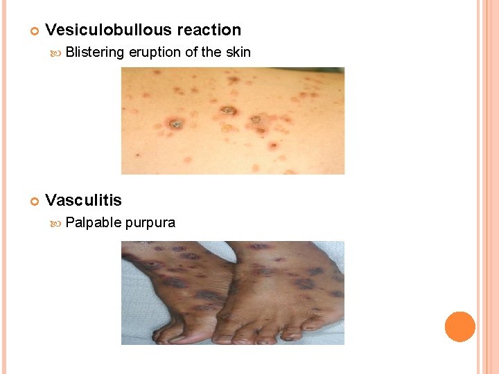  Vesiculobullous reaction Blistering eruption of the skin Vasculitis Palpable purpura 