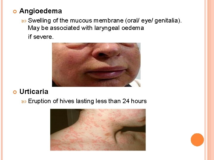  Angioedema Swelling of the mucous membrane (oral/ eye/ genitalia). May be associated with