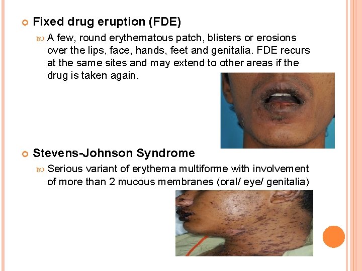  Fixed drug eruption (FDE) A few, round erythematous patch, blisters or erosions over