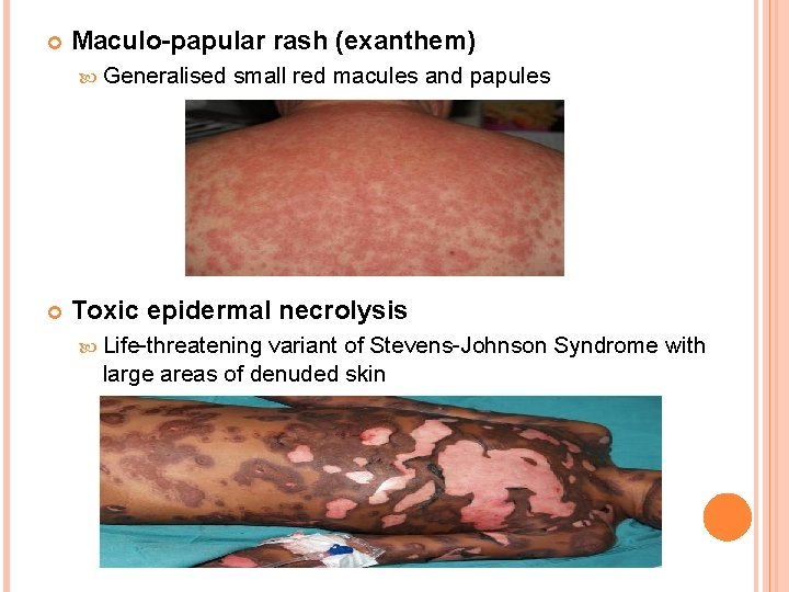  Maculo-papular rash (exanthem) Generalised small red macules and papules Toxic epidermal necrolysis Life-threatening