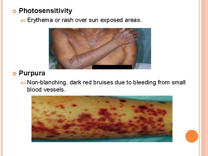  Photosensitivity Erythema or rash over sun exposed areas. Purpura Non-blanching, dark red bruises