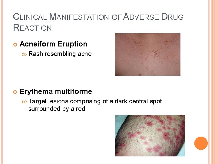 CLINICAL MANIFESTATION OF ADVERSE DRUG REACTION Acneiform Eruption Rash resembling acne Erythema multiforme Target