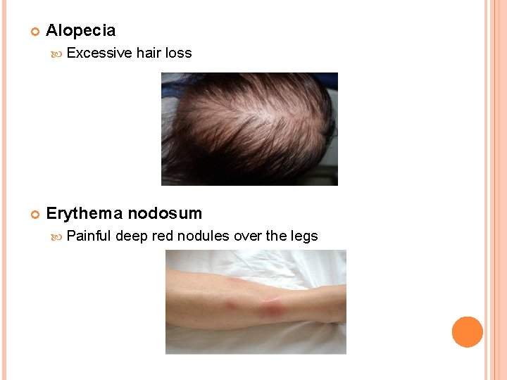  Alopecia Excessive hair loss Erythema nodosum Painful deep red nodules over the legs
