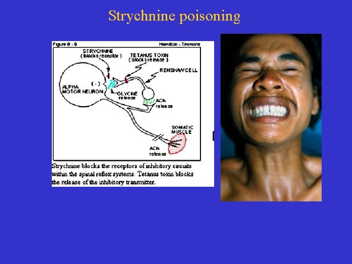 Strychnine poisoning 