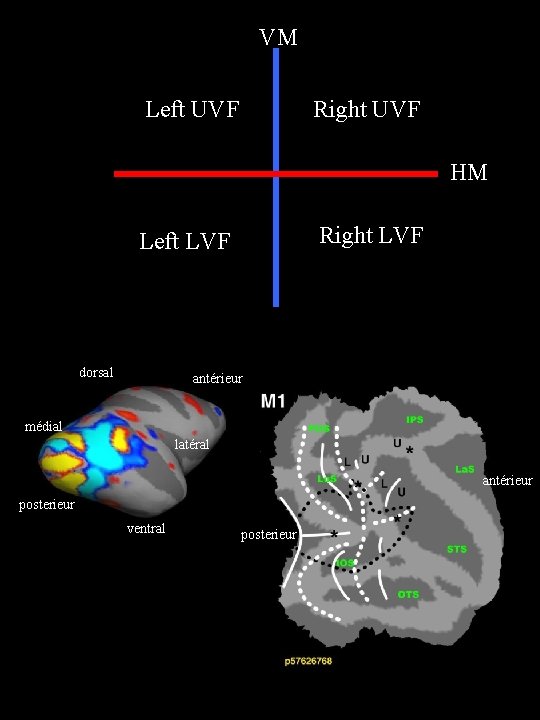 VM Left UVF Right UVF HM Right LVF Left LVF dorsal antérieur médial latéral