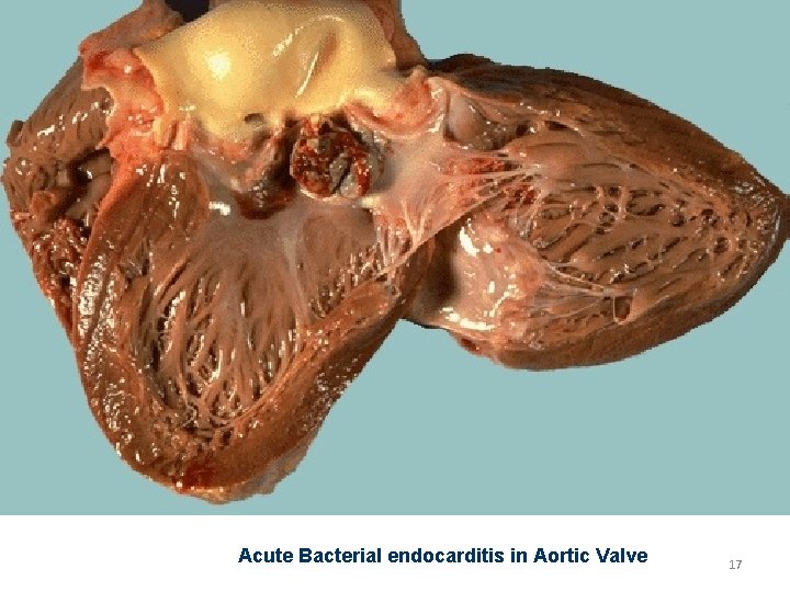 Acute Bacterial endocarditis in Aortic Valve 17 