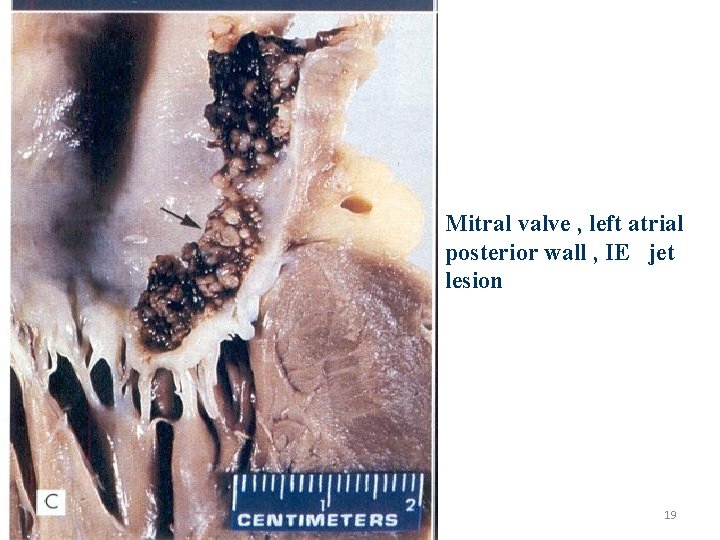 Mitral valve , left atrial posterior wall , IE jet lesion 19 