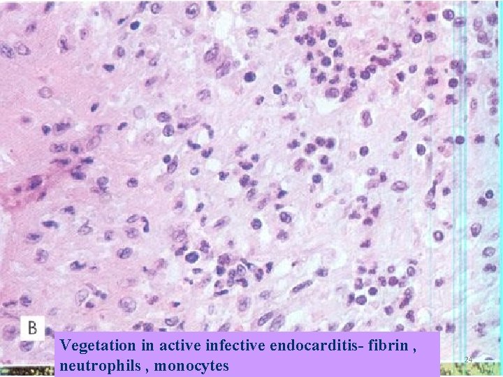 Vegetation in active infective endocarditis- fibrin , neutrophils , monocytes 24 