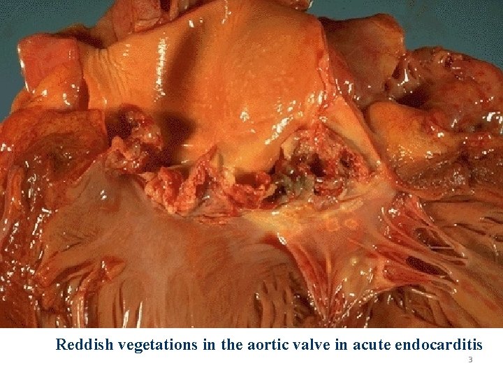 Reddish vegetations in the aortic valve in acute endocarditis 3 