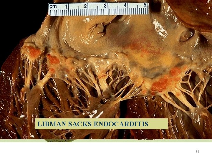 LIBMAN SACKS ENDOCARDITIS 34 