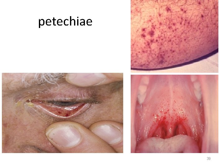 petechiae 39 