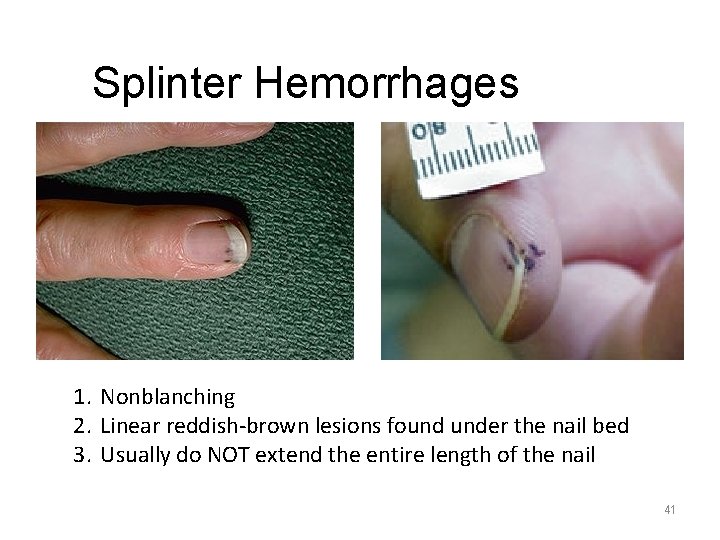 Splinter Hemorrhages 1. Nonblanching 2. Linear reddish-brown lesions found under the nail bed 3.