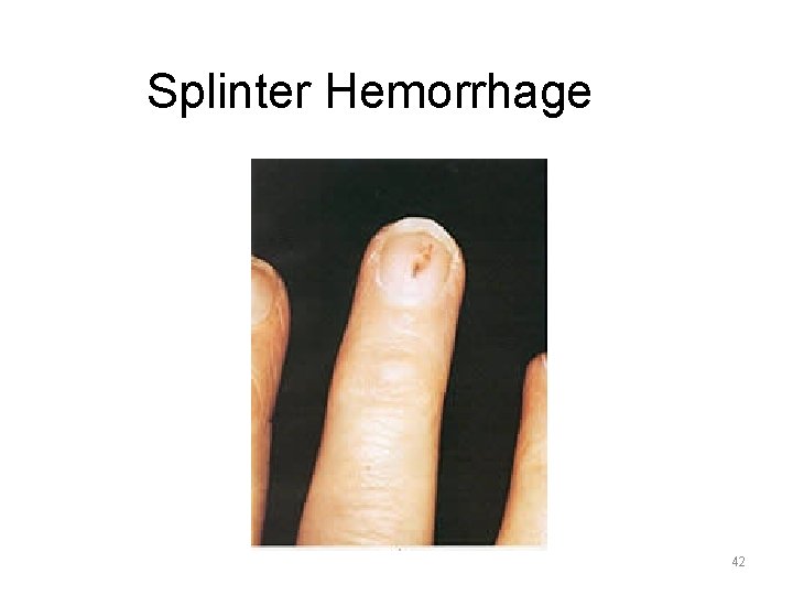 Splinter Hemorrhage 42 
