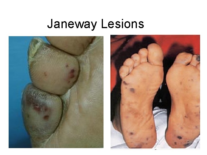 Janeway Lesions 44 